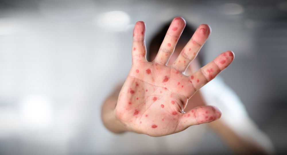 萨摩亚和斐济死于麻疹瘟疫的人数不断增加